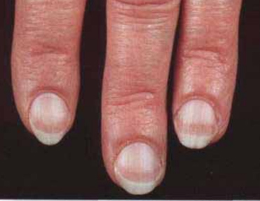 Деформация ногтя: причины и лечение